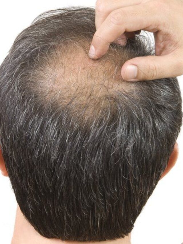 How To Reverse Baldness In Male - Bright Cures