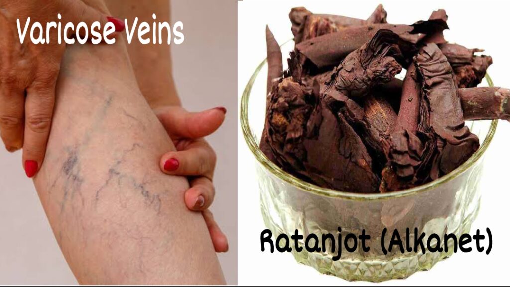 How To Use Ratanjot For Varicose Veins Athletes