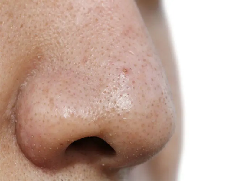 How To Get Rid Of Black Spots On Nose