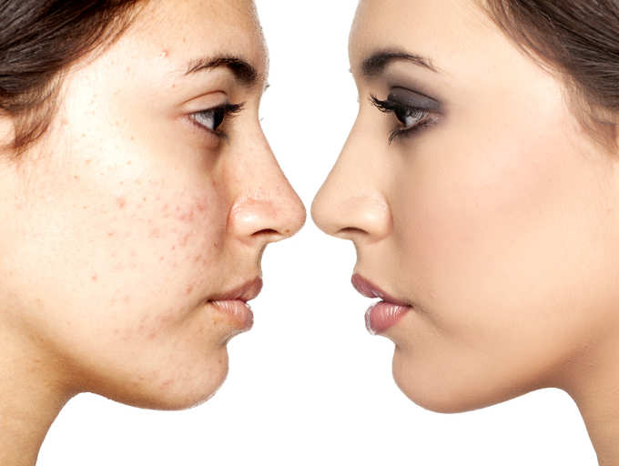 How To Get Rid Of Blemishes At Home