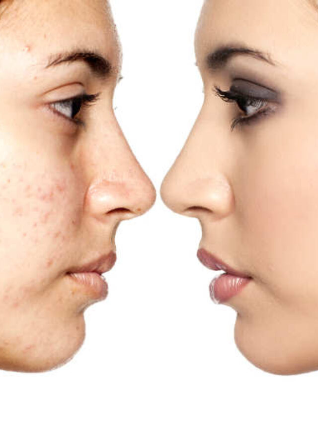 How To Get Rid Of Blemishes At Home Naturally