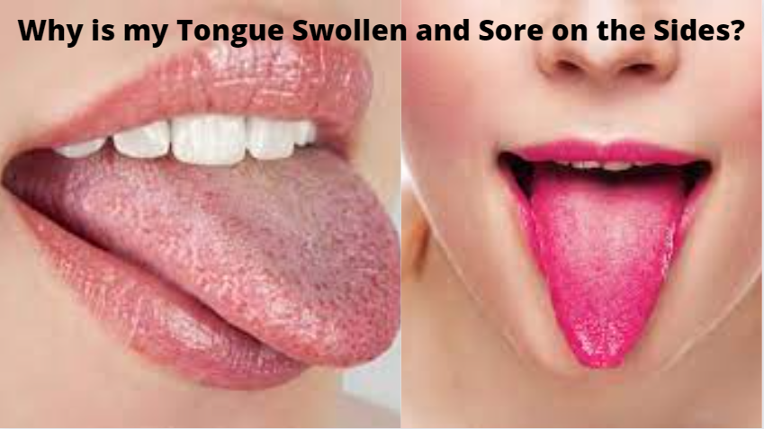 Why Is My Tongue Swollen And Sore On The Sides Bright Cures