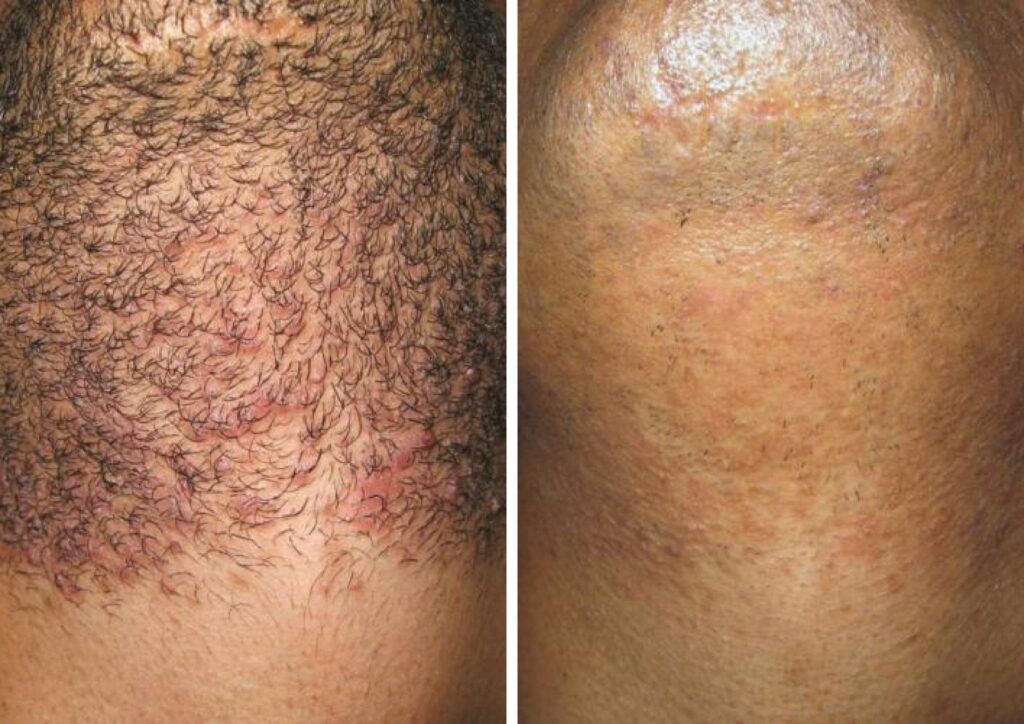 Full Brazilian Laser Hair Removal Before And After Photos